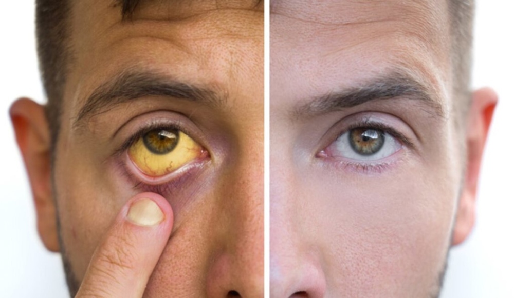 Перші симптоми гепатиту А в дітей і дорослих